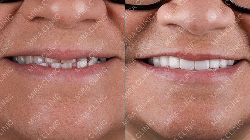 Hollywood smile Before - After patient reviews 